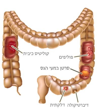 התרפאתי בעצמי מגידול במעי
