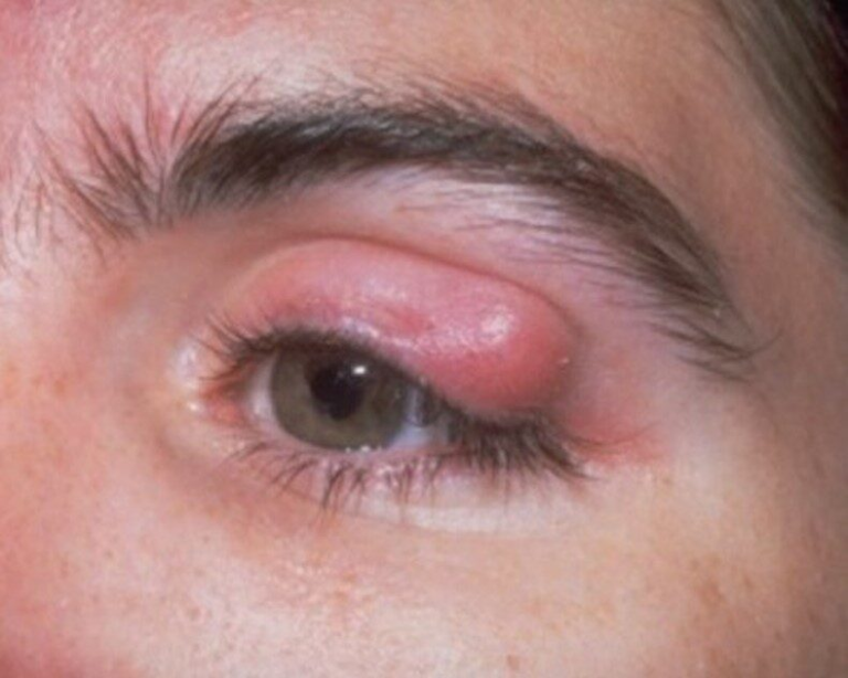 Chalazion-1